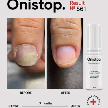 Aceite regenerador contra onicolisis - OniStop 15ml NAILSOFTHEDAY