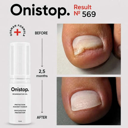 Aceite regenerador contra onicolisis - OniStop 15ml NAILSOFTHEDAY