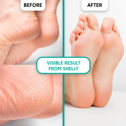 Keratolytic Gel For Removing Callueses And Corns Shelly 200 ml