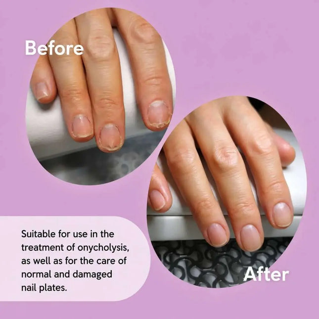 Oil For Damaged Nail Plate Stop Onycholychis Shelly 30 ml